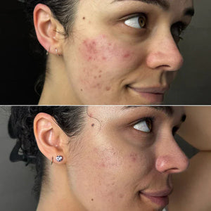 Terapia con luz roja antes y después: imágenes y resultados