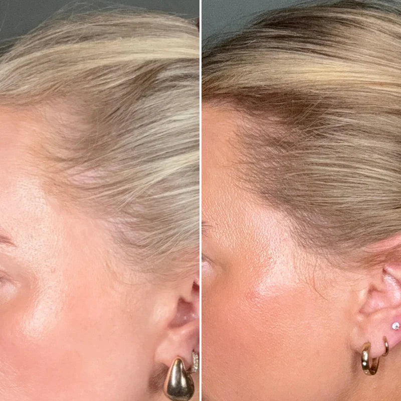 ¿Cuáles son las principales causas de la caída del cabello en las mujeres y es reversible?