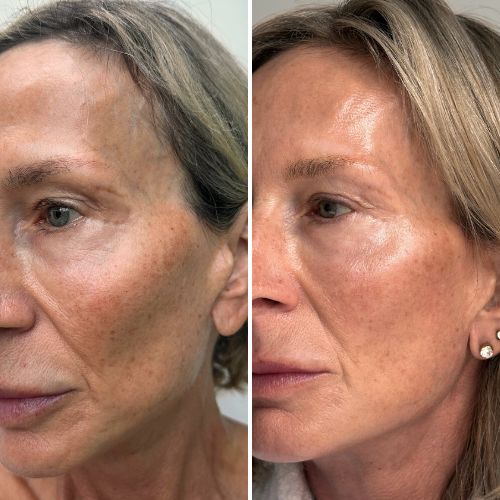 Before & After