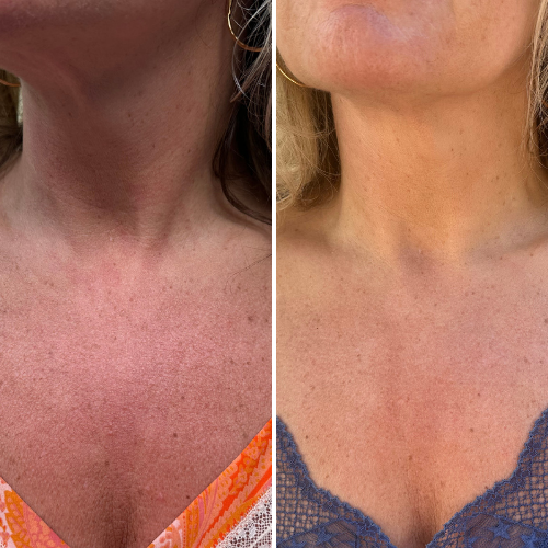 Before & After