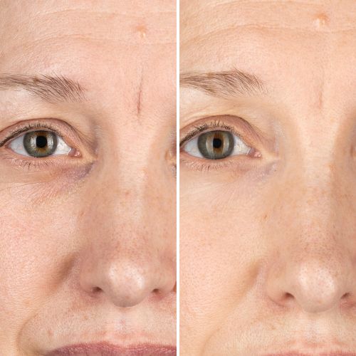 Before & After