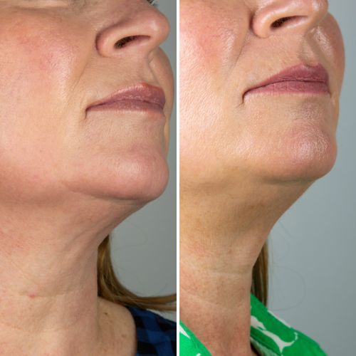 Before & After