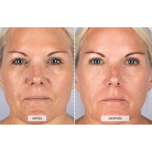 Aparato de Radiofrecuencia Facial Currentbody Skin