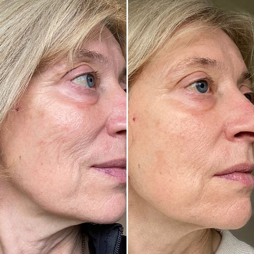 Before & After
