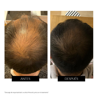 Oferta CurrentBody Skin Dispositivo LED para la regeneración del cabello