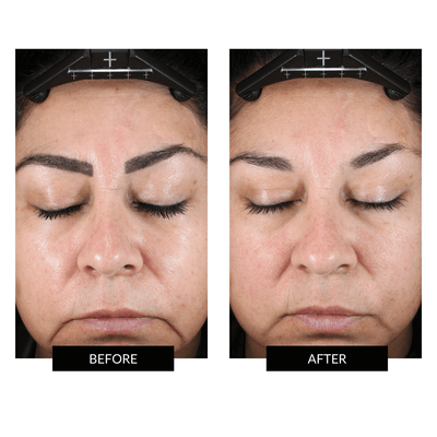 Kit Completo NuFACE TRINITY+ para una tonificación facial superior