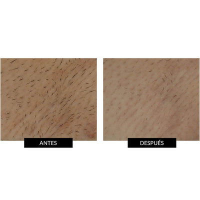 Smoothskin Bare + antes y después