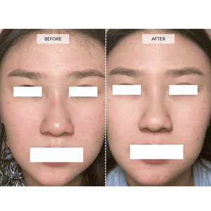 CurrentBody Skin LED 4-en-1 Máscara con Mapeo facial edición limitada