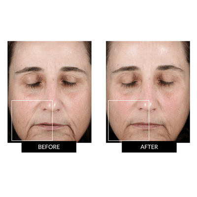 Kit Completo NuFACE TRINITY+ para una tonificación facial superior