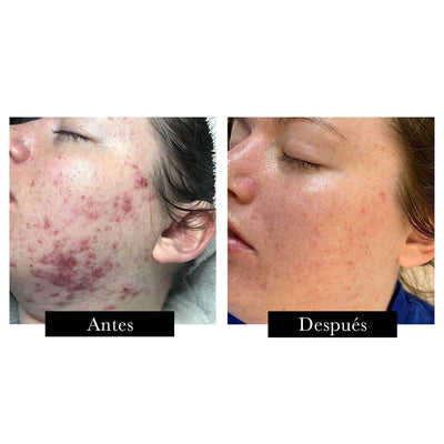 Dermalux Flex MD