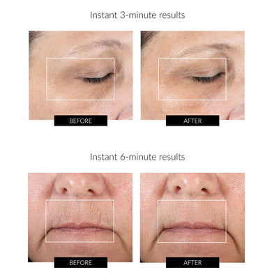 NuFACE FIX Régimen Atenuador de Líneas Finas Edición Limitada
